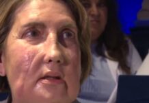 Ισπανία: Μεταμόσχευση προσώπου από δότρια που έκανε ευθανασία