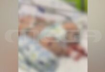 Ματίνα Παγώνη για Ζάκυνθο: «Δεν έχουμε θανάτους από ιογενή μηνιγγίτιδα – Από φωτογραφίες δεν μπορούμε να βγάζουμε διαγνώσεις»