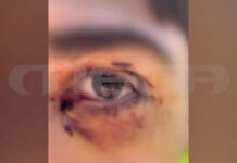 Ιωάννινα: 16χρονος δέχτηκε επίθεση από άλλους ανήλικους – Παρ’ ολίγον να χάσει το μάτι του